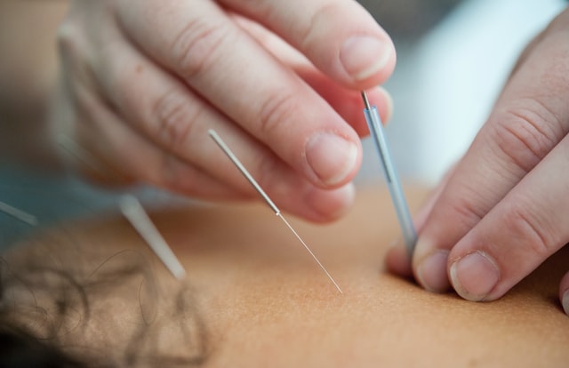 Acupuncture and Chiropractic